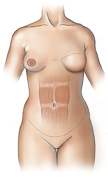Figure 4 - Left breast reconstruction with DIEP flap. Note the intact rectus abdominis muscle.