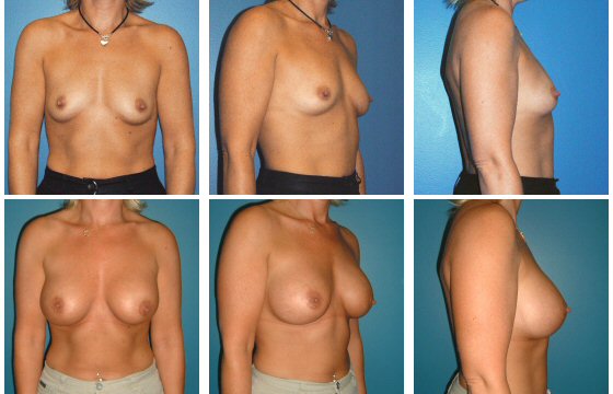 Breast Enhancement