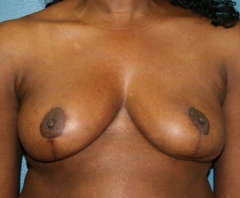 breast reduction postop
