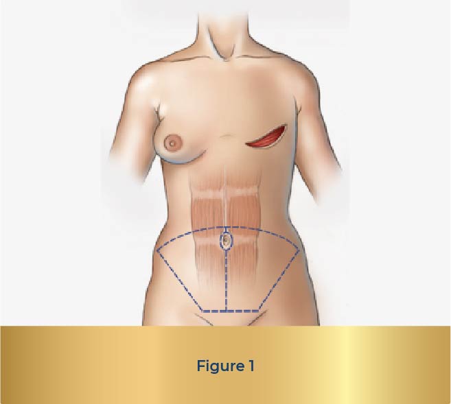 Autogenous Reconstruction