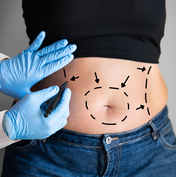 Abdominoplasty-Surgical-Process-1