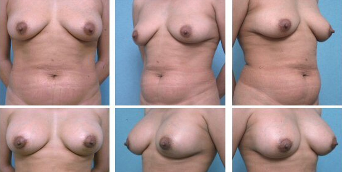 <b>Breast Augmentation:</b> Breast Augmentation | 35 years old, 5'6" and 145 lbs, 3 children. Pre-op cup size of B, post-op cup size of D. Peri-areolar incision, sub-pectoral pocket, Inamed smooth round implant (375cc). Photos from 4 weeks post-op.