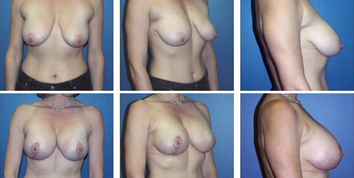 <b>Breast Augmentation:</b> Breast Lift/Augmentation | 40 years old, 5'7" and 132 lbs, 2 children. Pre-op cup size of B/C, post-op cup size of D. Wise-pattern mastopexy incision, sub-pectoral pocket, Inamed smooth round implant (330cc). Photos from 1 month post-op.