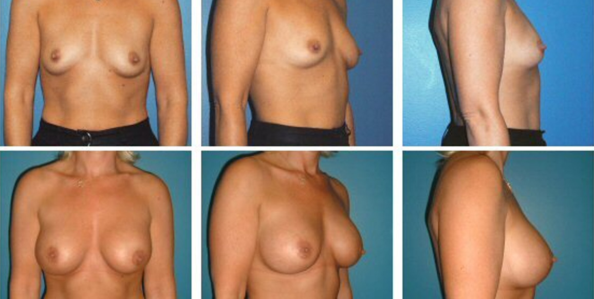 <b>Breast Augmentation:</b> Breast Augmentation | 37 years old, 5'4" and 125 lbs, 2 children. Pre-op cup size of A, post-op cup size of C. Peri-areolar incision, sub-pectoral pocket, Inamed smooth round implant (300cc inflated to 330cc). Photos from 11 months post-op.