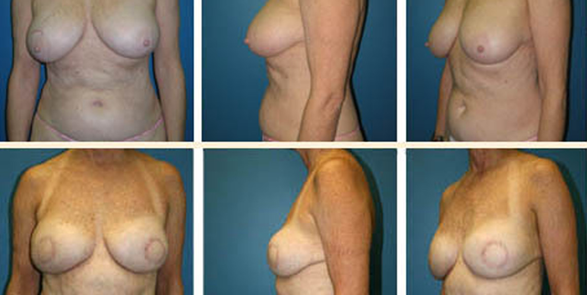 <b>DIEP Flap Reconstruction:</b> Breast Reconstruction | A 58-year-old patient pre- and five months post-op bilateral mastectomies and immediate DIEP flaps.