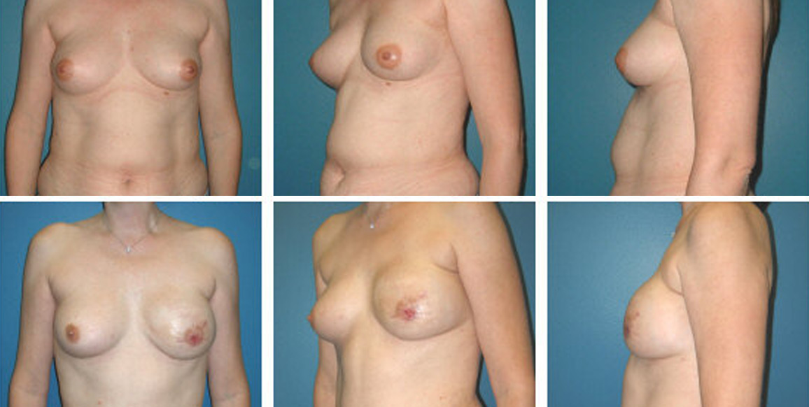 <b>DIEP Flap Reconstruction:</b> Breast Reconstruction | 32-year-old female with left breast cancer, treated with nipple-sparing mastectomy and immediate DIEP flap reconstruction Type: Deep Inferior Epigastric Perforator (DIEP) flaps. Pictures taken 2 months post-op.