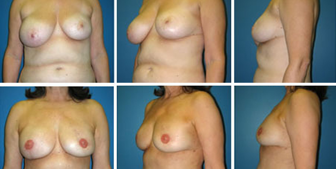 <b>DIEP Flap Reconstruction:</b> Breast Reconstruction | 59-year-old female with a history of left breast carcinoma previously treated with lumpectomy, radiation, and axillary dissection. She developed local recurrence of carcinoma of the left breast 13 years after initial treatment. She underwent bilateral mastectomies and immediate breast reconstruction with Deep Inferior Epigastric Perforator (DIEP) flaps. She subsequently underwent nipple reconstruction and nipple/areolar tattooing. Pictures taken 10 months post-op.