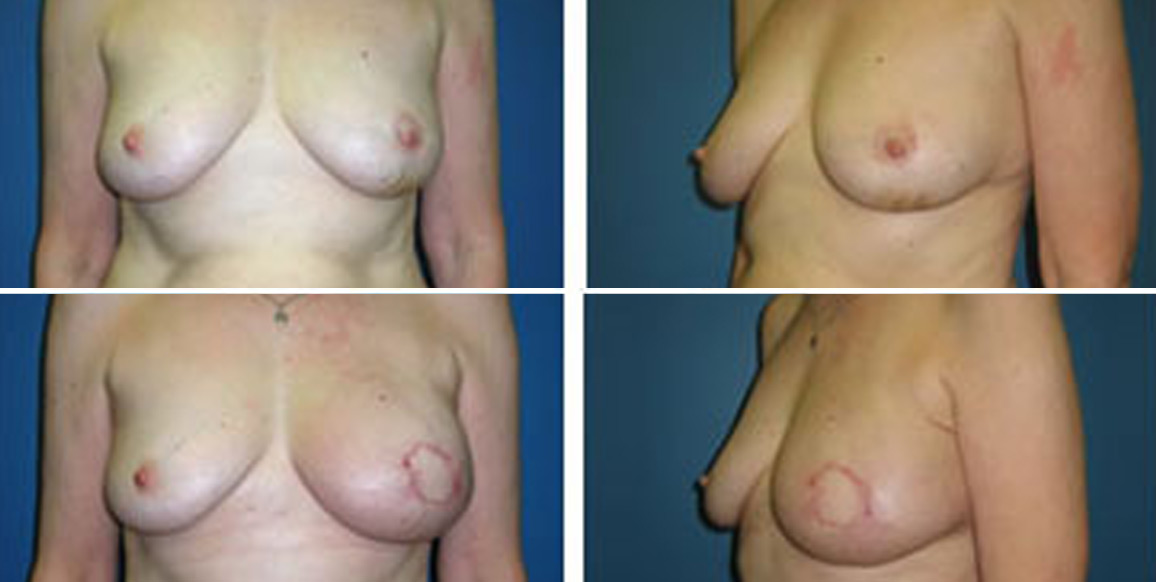 <b>DIEP Flap Reconstruction:</b> Breast Reconstruction | 58-year old female with left breast cancer shown before and one month after a DIEP flap for left breast reconstruction.