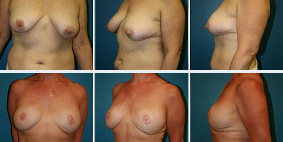 <b>DIEP Flap Reconstruction:</b> Breast Reconstruction | 57-year-old with invasive ductal carcinoma of the left breast. She underwent neoadjuvant chemotherapy followed by bilateral mastectomies and immediate reconstruction with DIEP flaps. The post-op photos were taken eight months after nipple reconstruction, and 18 months after the DIEP flaps.