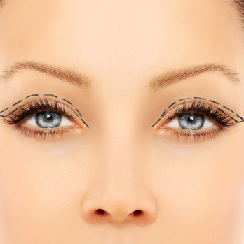 Eyelid-Surgery-(Blepharoplasty)-Surgical-Process-2