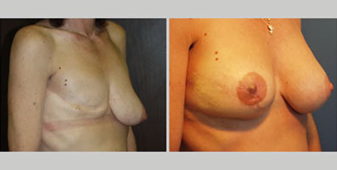 <b>Free Tram Reconstruction:</b> 48-year-old who had previously undergone right mastectomy. The post-op photo is 1 year after free TRAM right breast reconstruction and augmentation mastopexy of the left breast, four months after nipple reconstruction, and two months after nipple/areolar tattooing.