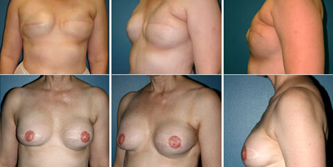 <b>Gracilis Flap Reconstruction:</b> Breast Reconstruction | 43-year-old female with a history of left breast cancer who underwent bilateral mastectomies followed by radiation and chemotherapy. She had placement of tissue expanders at an outside institution and was referred to Dr. Kind following herniation and impending exposure of her left breast tissue expander. The pictures shown are pre- and post-gracilis (inner thigh muscle) myocutaneous microvascular flap for breast reconstruction. To reach the patient's desired breast volume, silicone implants were placed. She then underwent nipple reconstruction and tattooing. Post-op photos are 2 years after nipple reconstruction and tattooing.