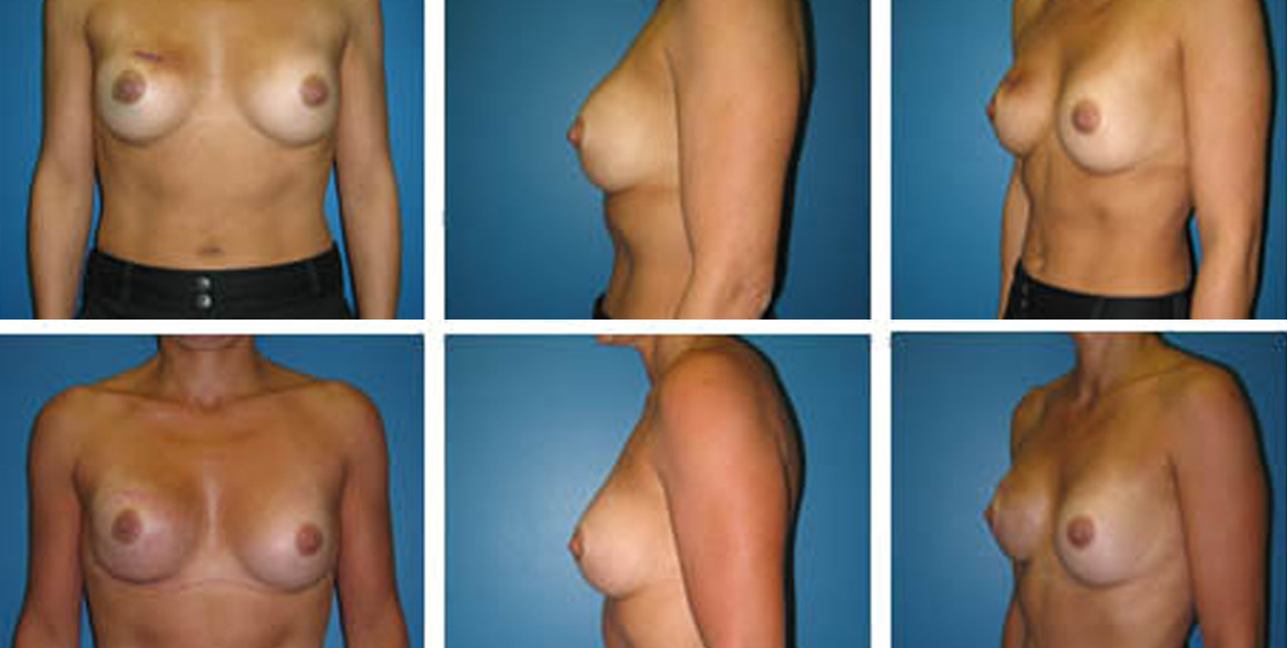 <b>Implant Reconstruction:</b> Breast Reconstruction | 45-year-old female with a history of breast augmentation who now has right breast cancer. The post-op photos are 4 months after right mastectomy and single-stage reconstruction with Alloderm and a silicone gel implant.