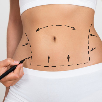 Liposuction-Process-2