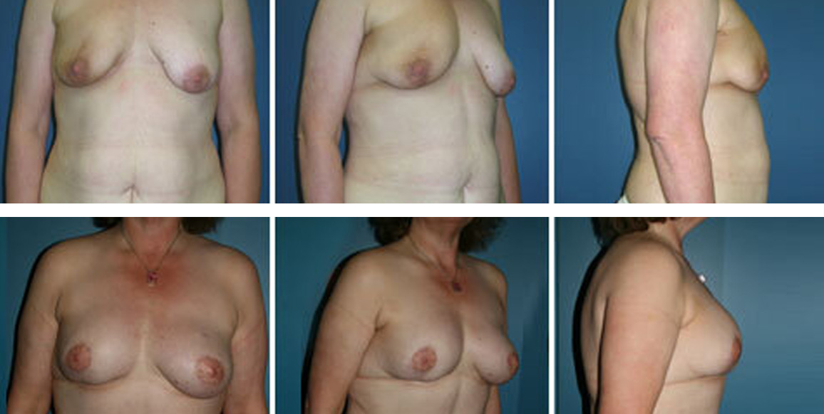 <b>SIEA Flap Reconstruction:</b> Breast Reconstruction | 43-year-old with a history of right breast cancer, who has undergone a partial mastectomy and radiation therapy. She underwent bilateral mastectomies and reconstruction with Superficial Inferior Epigastric Artery flaps. The post-op photos were taken 3 years later.