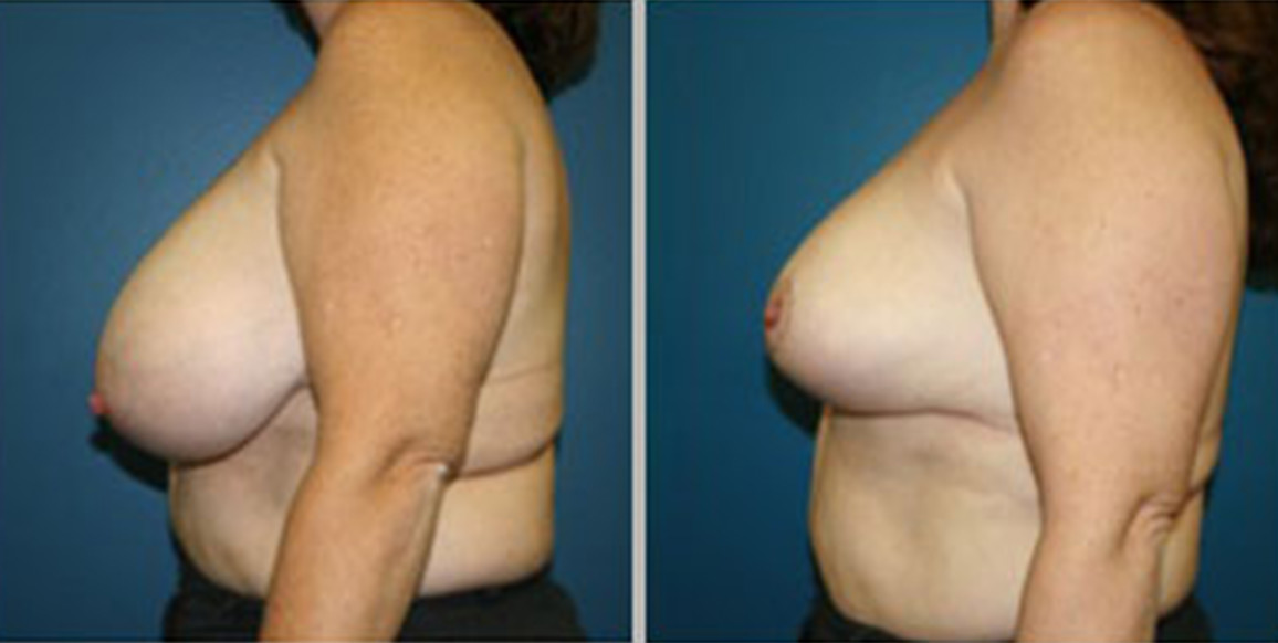 <b>Breast Reduction:</b> 45 year old woman 6 weeks after breast reduction through vertical incision.