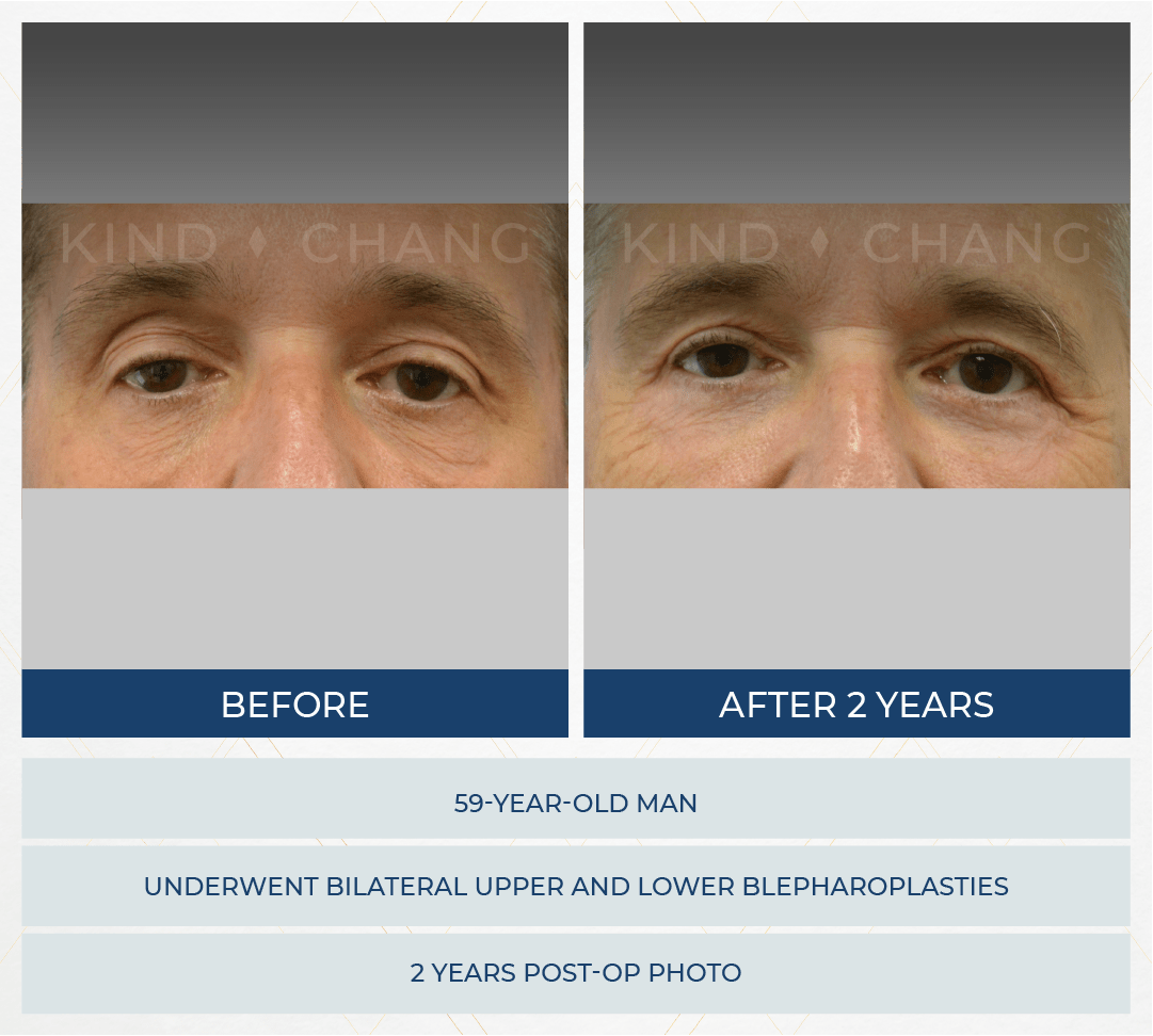 Kind Chang Before After - Blepharoplasty