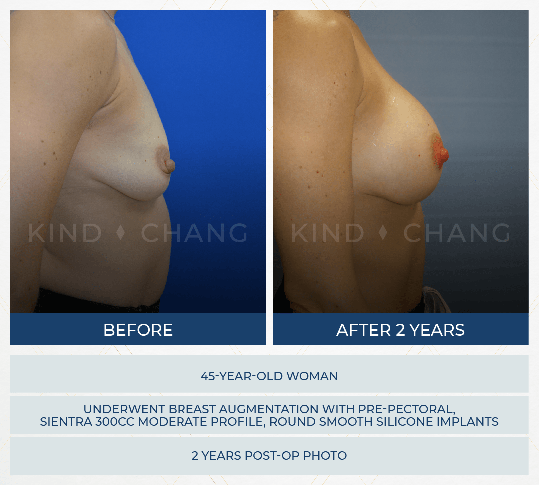 Kind Chang Before After - Breast Augmentation