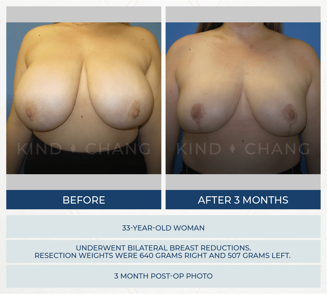 Kind Chang Before After - Breast Reduction