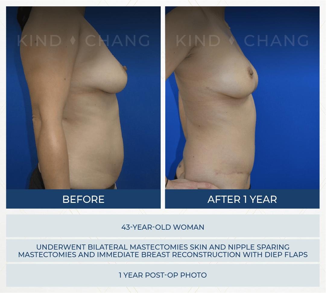 Kind Chang Before After - DIEP Flap