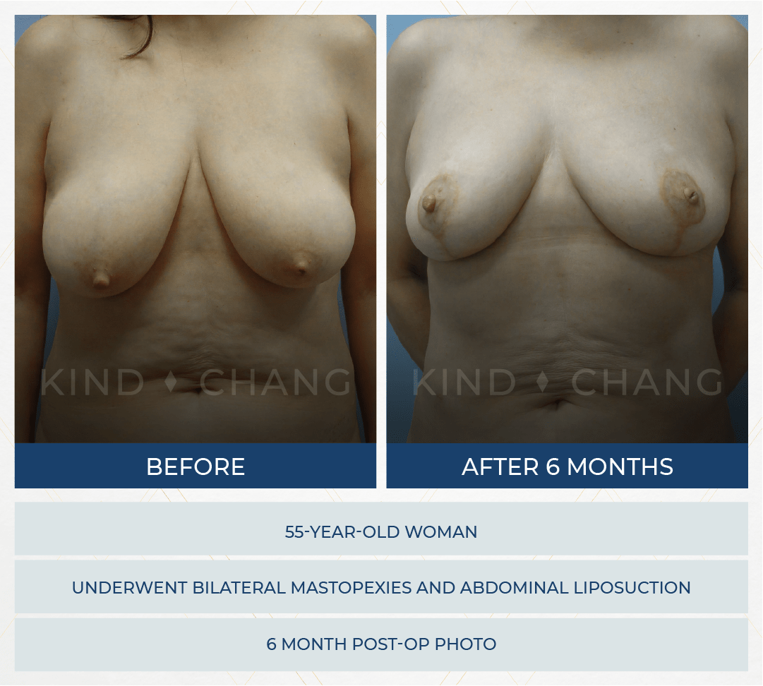 Kind Chang Before After - Mastopexy