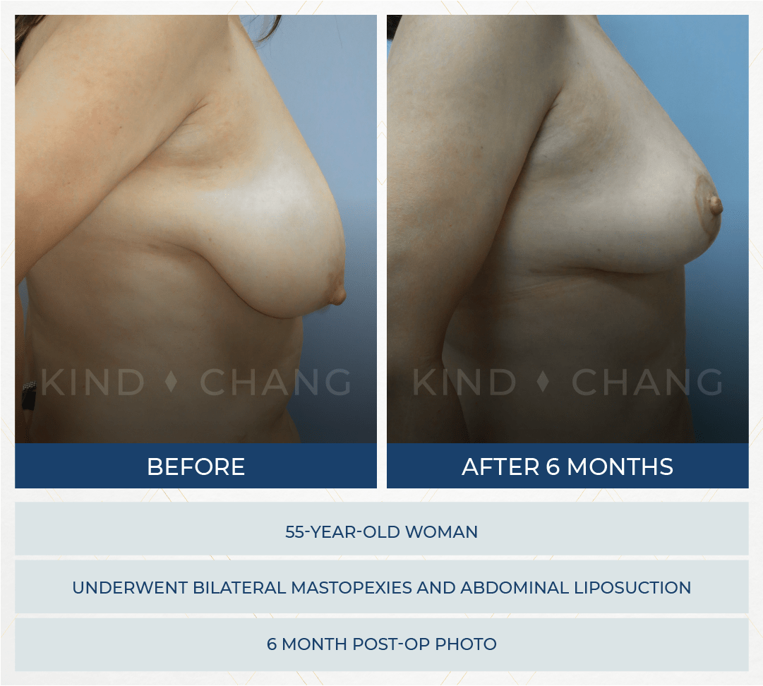 Kind Chang Before After - Mastopexy