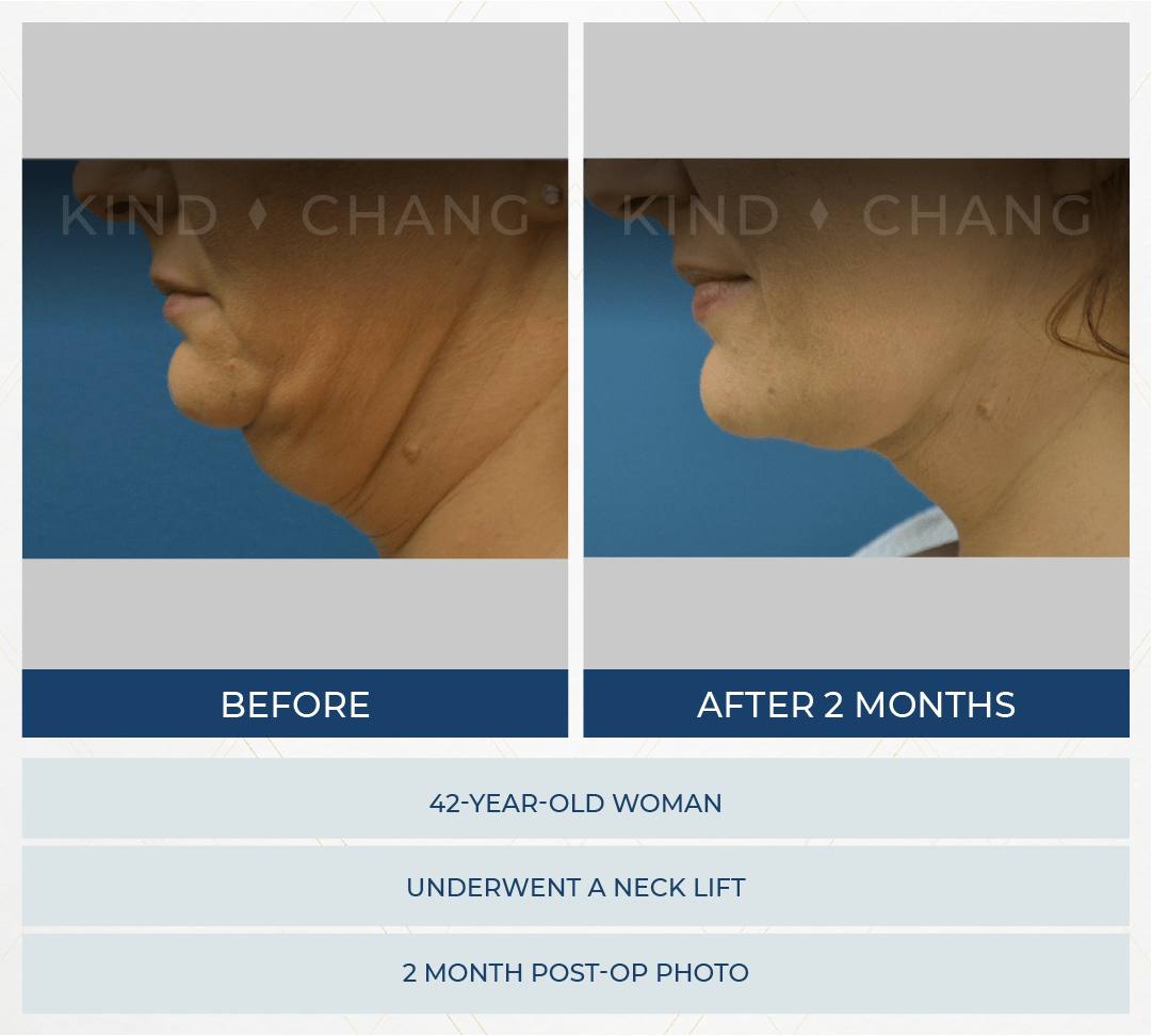 Kind Chang Before After - Neck Lift