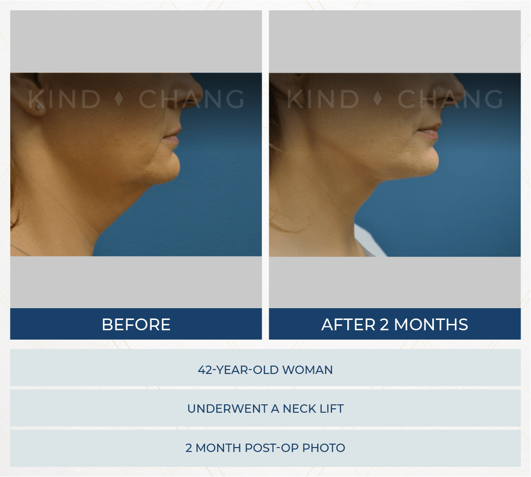 Kind Chang Before After - Neck Lift