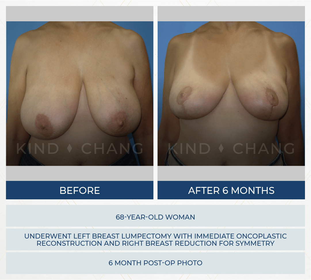 Kind Chang Before After - Oncoplastic Breast Reconstruction