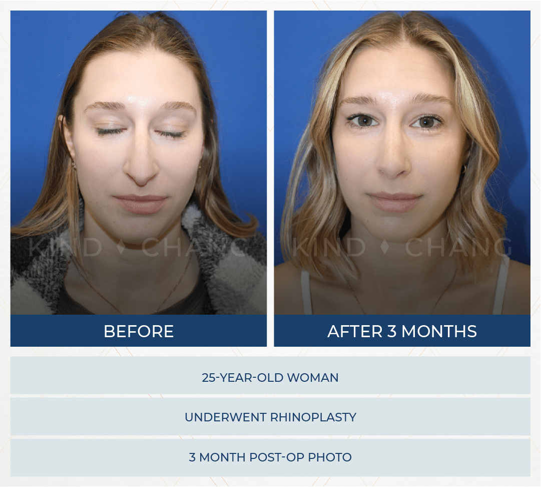 Kind Chang Before After - Rhinoplasty