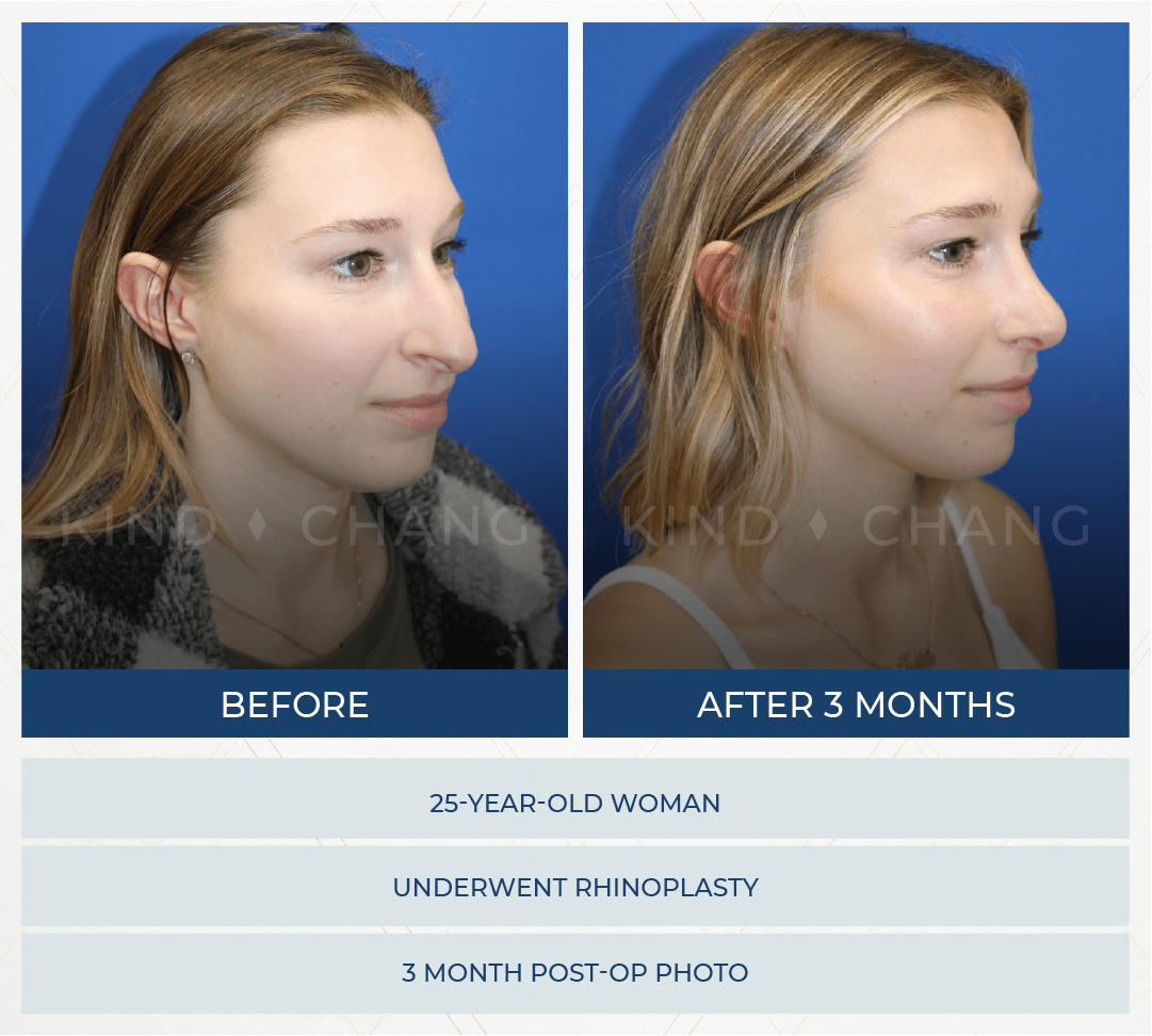 Kind Chang Before After - Rhinoplasty