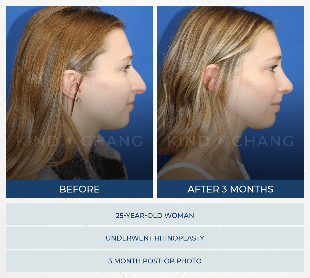 Kind Chang Before After - Rhinoplasty