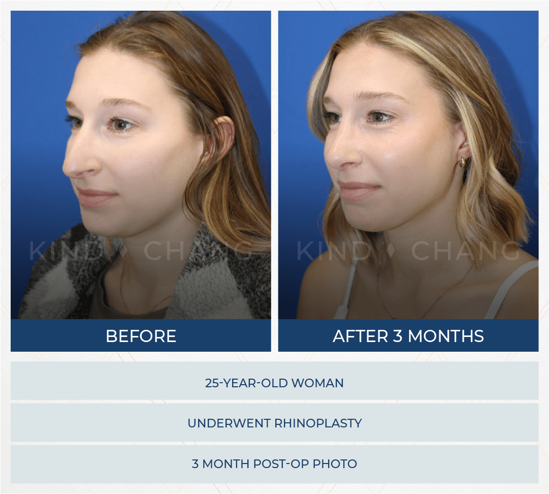 Kind Chang Before After - Rhinoplasty