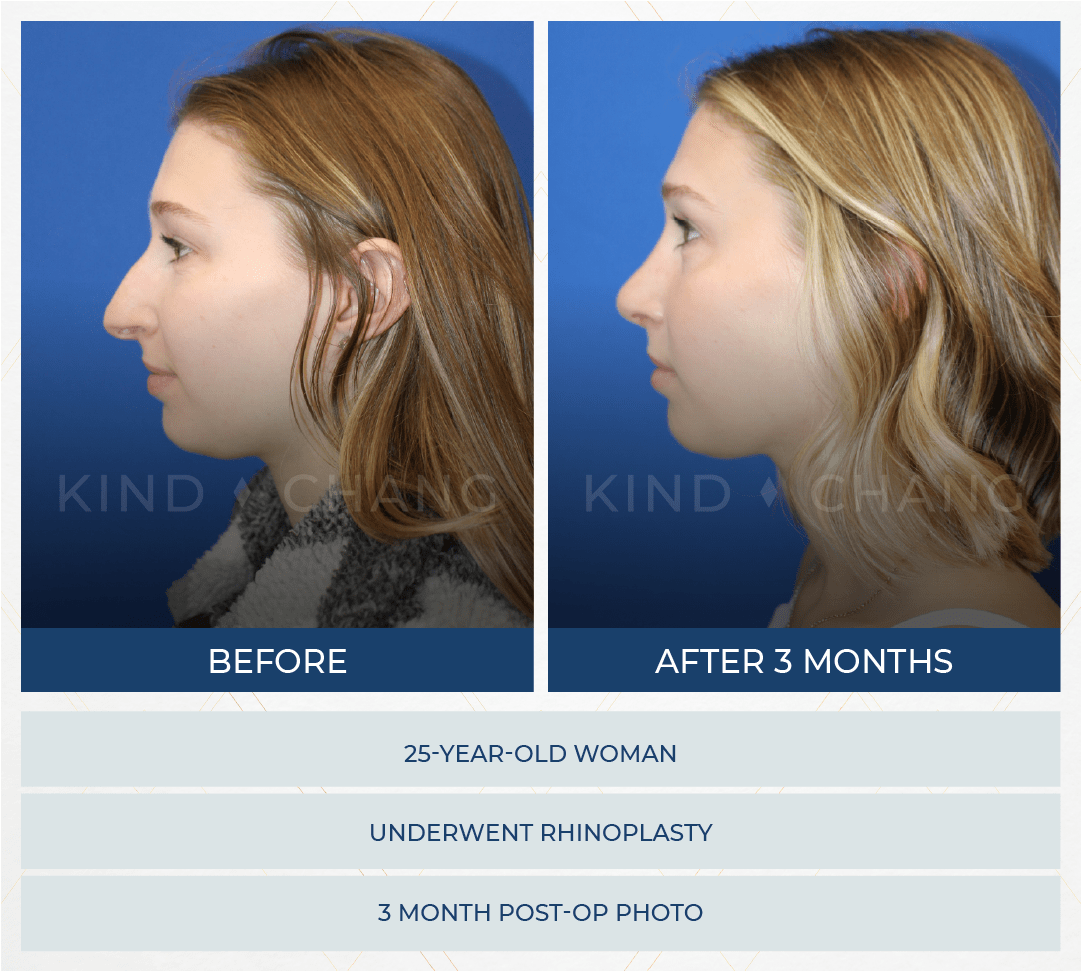 Kind Chang Before After - Rhinoplasty